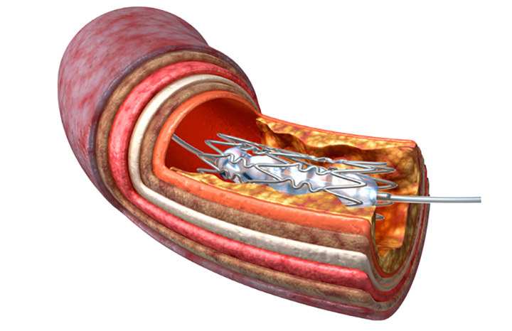 Chemoembolization | NorthShore