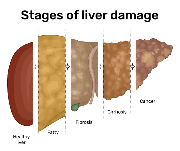 Are You At Risk For Fatty Liver Disease NorthShore Clinical Study Is 